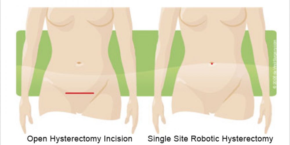 Single Site Robotic Hysterectomy